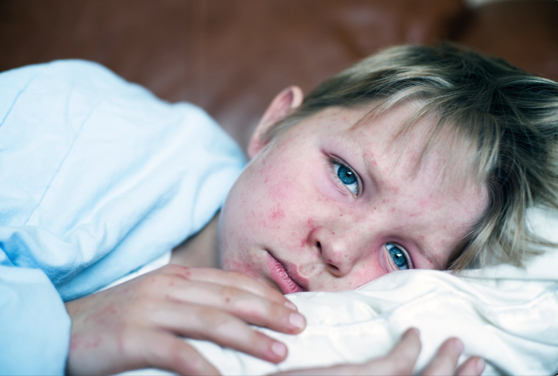 Measles rash and immunity information guide for prevention and protection during outbreak